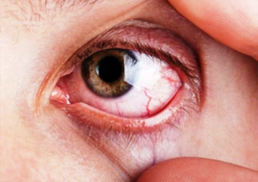 Cirugía de glaucoma 