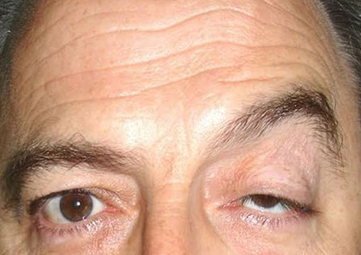 Cirugía de ptosis palpebral (párpado caído)