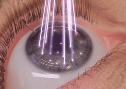 Cirugía refractiva 
