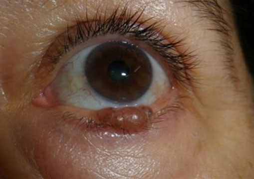 Tumores de párpados, órbita y superficie ocular